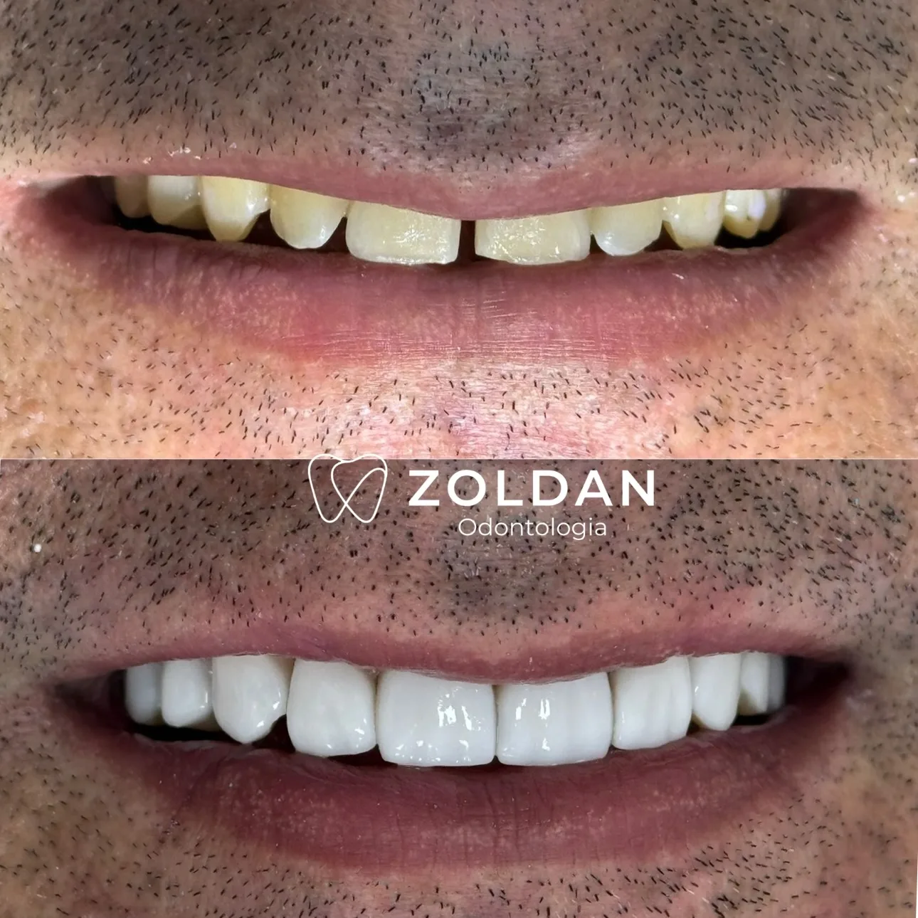 Antes e depois 2